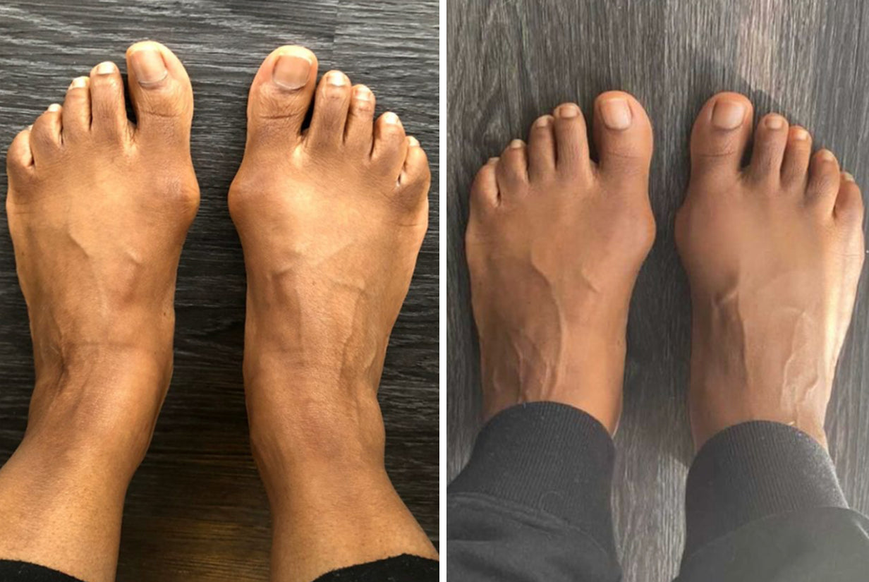 before-and-after-correct-toes-bunion-reversal