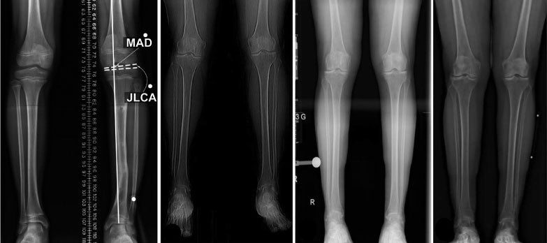 Leg Length Discrepancy