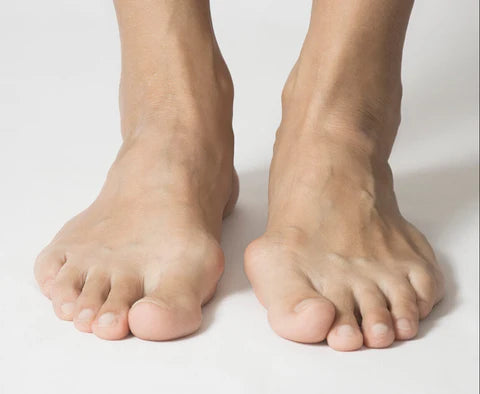 Barefeet with bunion on left foot