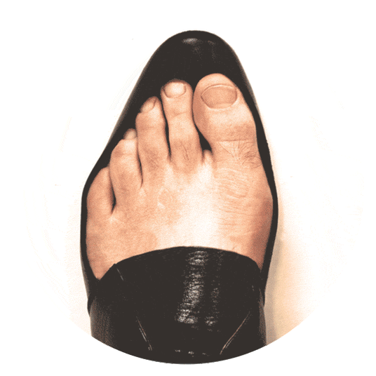 Gif of xray of deformed foot bones of a bunion