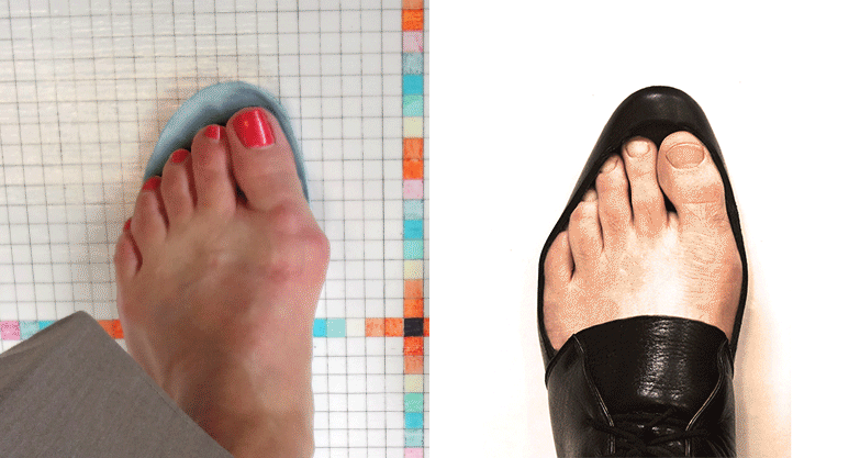 The Hereditary Bunion Myth: Part I