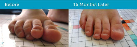 Before and after childs feet with crooked toes