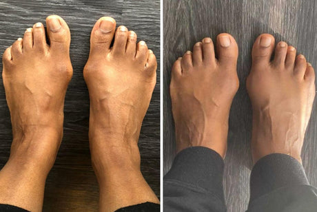 before-and-after-correct-toes-bunion-reversal