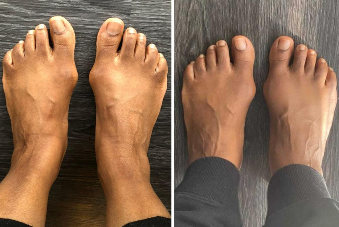 before-and-after-correct-toes-bunion-reversal