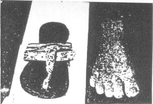 Conclusions Drawn from a Comparative Study of the Feet of Barefooted and Shoe-Wearing Peoples