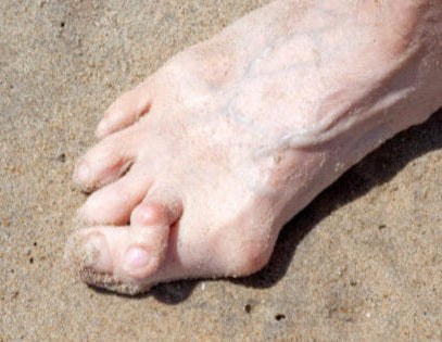 Second toe crossing over big toe