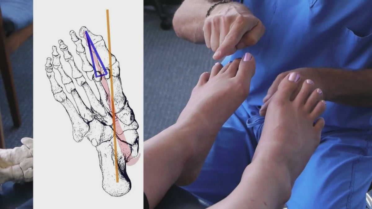 Correct Toes® | The Original Toe Spacers
