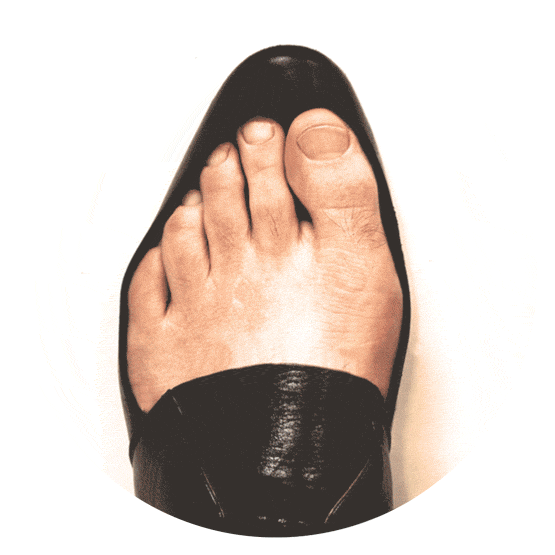 Gif of xray of deformed foot bones of a bunion
